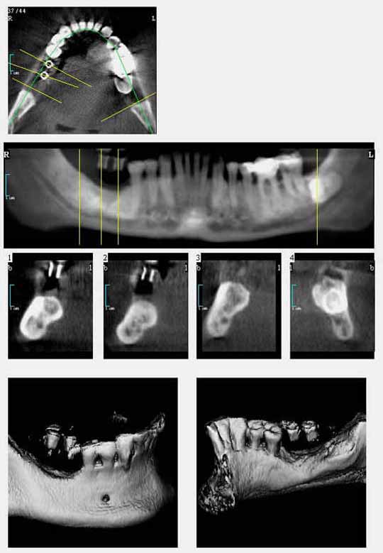 Implantatplanung